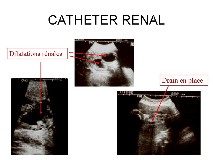 CATHETER RENAL Dilatations rénales Drain en place 