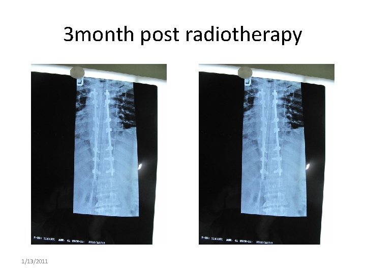 3 month post radiotherapy 1/13/2011 