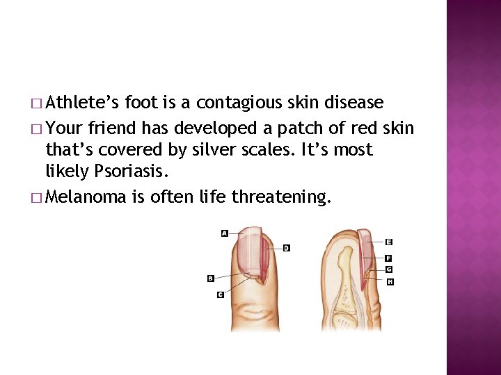 � Athlete’s foot is a contagious skin disease � Your friend has developed a