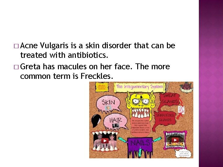 � Acne Vulgaris is a skin disorder that can be treated with antibiotics. �