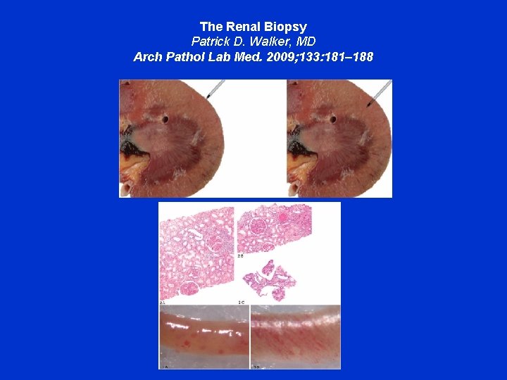 The Renal Biopsy Patrick D. Walker, MD Arch Pathol Lab Med. 2009; 133: 181–