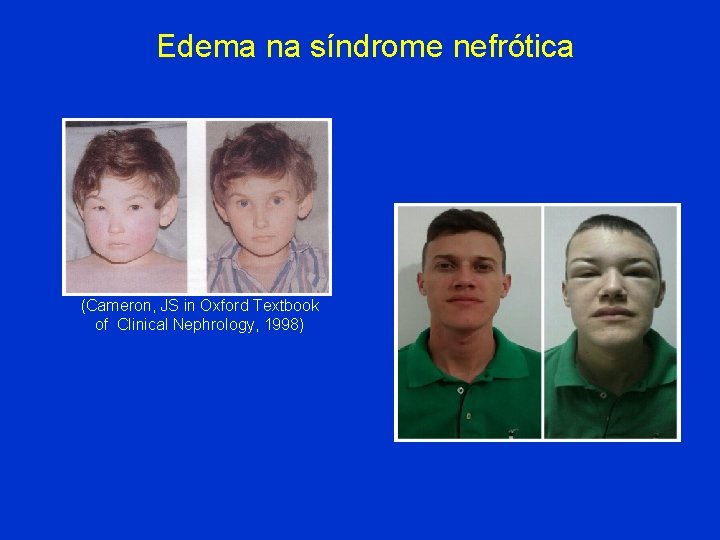 Edema na síndrome nefrótica (Cameron, JS in Oxford Textbook of Clinical Nephrology, 1998) 
