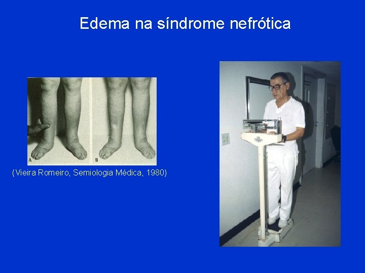 Edema na síndrome nefrótica (Vieira Romeiro, Semiologia Médica, 1980) 