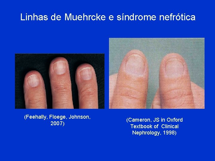 Linhas de Muehrcke e síndrome nefrótica (Feehally, Floege, Johnson, 2007) (Cameron, JS in Oxford