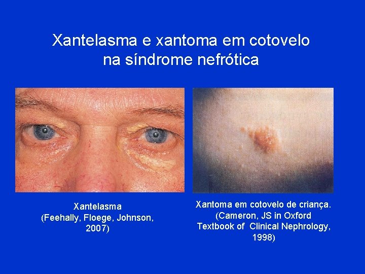 Xantelasma e xantoma em cotovelo na síndrome nefrótica Xantelasma (Feehally, Floege, Johnson, 2007) Xantoma