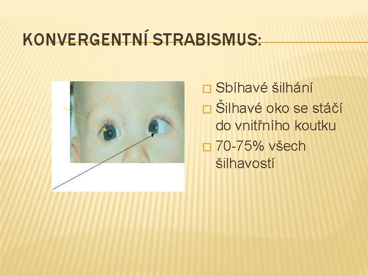 KONVERGENTNÍ STRABISMUS: Sbíhavé šilhání � Šilhavé oko se stáčí do vnitřního koutku � 70