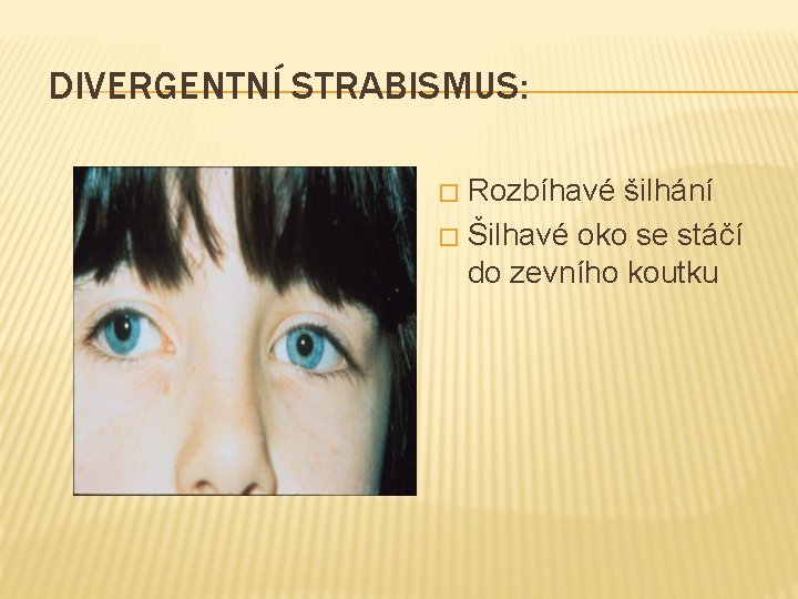DIVERGENTNÍ STRABISMUS: Rozbíhavé šilhání � Šilhavé oko se stáčí do zevního koutku � 