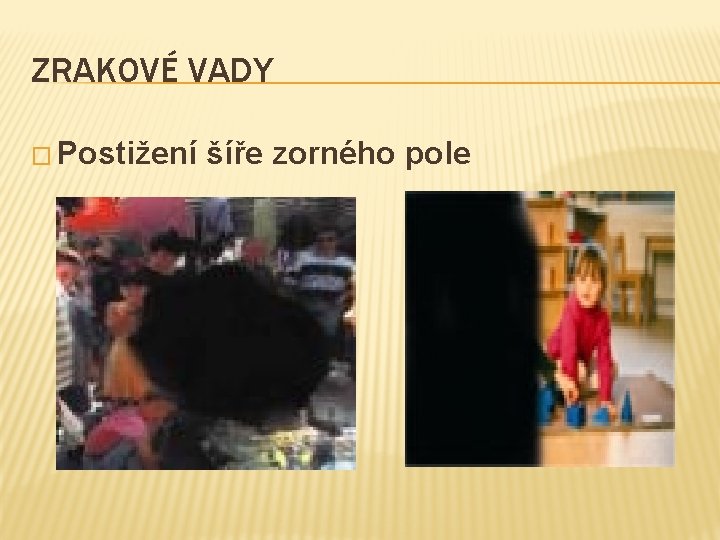 ZRAKOVÉ VADY � Postižení šíře zorného pole 