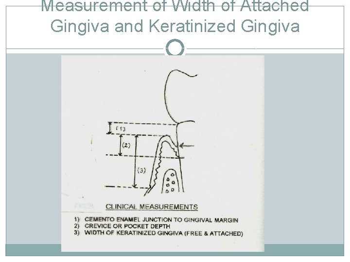 Measurement of Width of Attached Gingiva and Keratinized Gingiva 