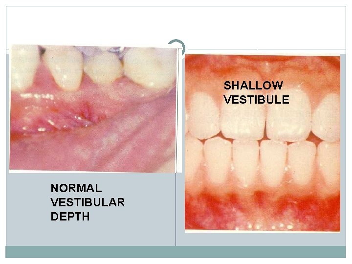 SHALLOW VESTIBULE NORMAL VESTIBULAR DEPTH 