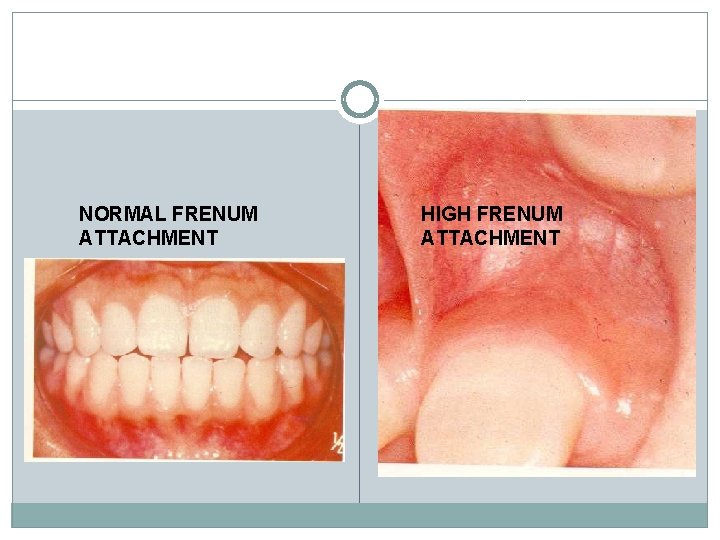 NORMAL FRENUM ATTACHMENT HIGH FRENUM ATTACHMENT 