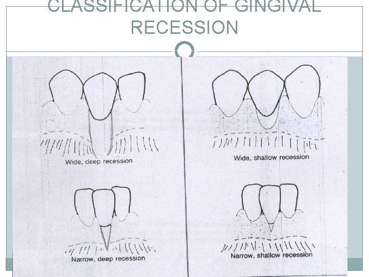 CLASSIFICATION OF GINGIVAL RECESSION 