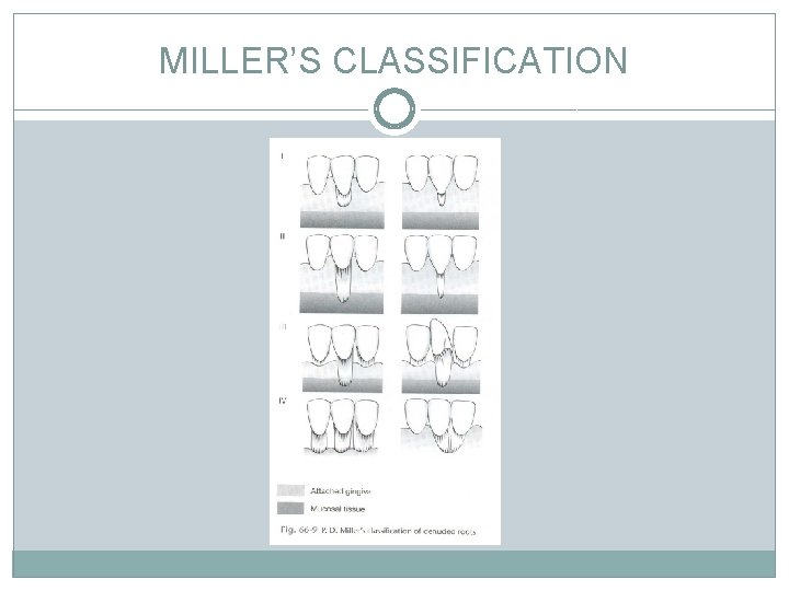 MILLER’S CLASSIFICATION 