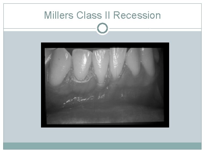 Millers Class II Recession 