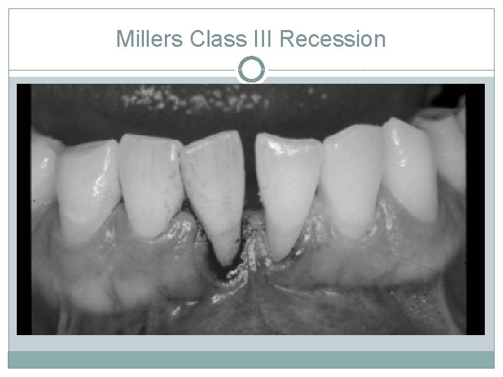 Millers Class III Recession 