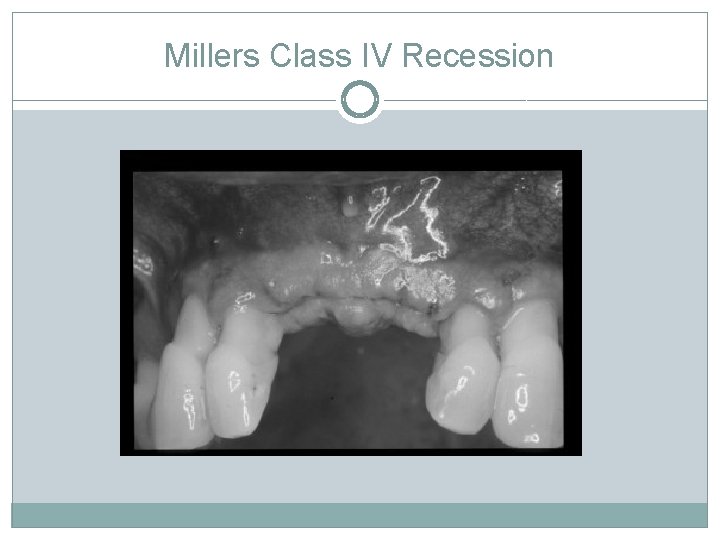 Millers Class IV Recession 