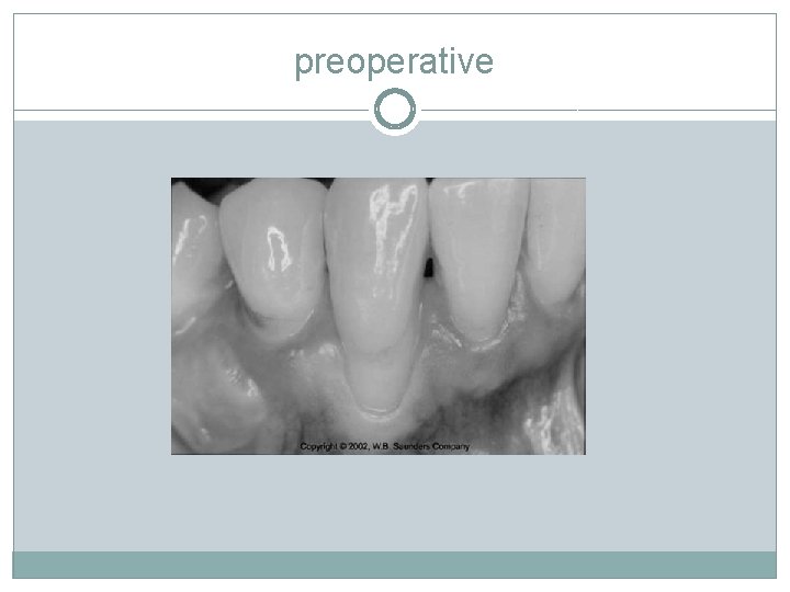 preoperative 