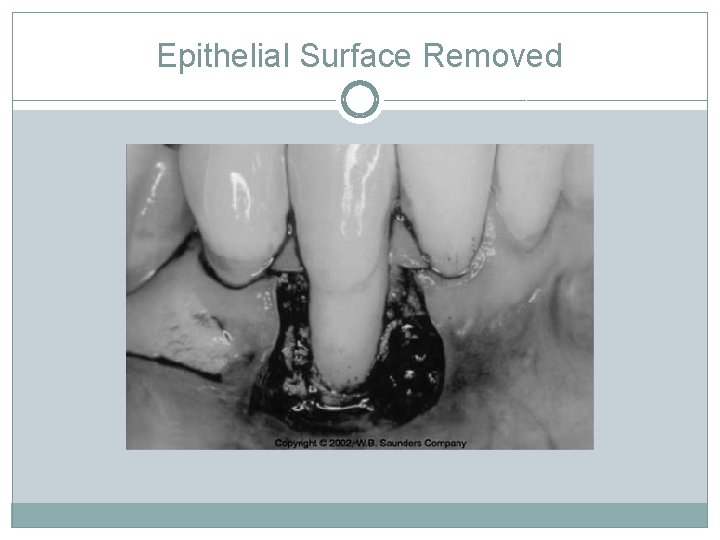 Epithelial Surface Removed 