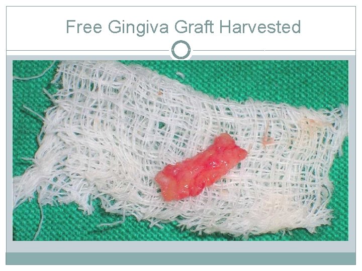 Free Gingiva Graft Harvested 