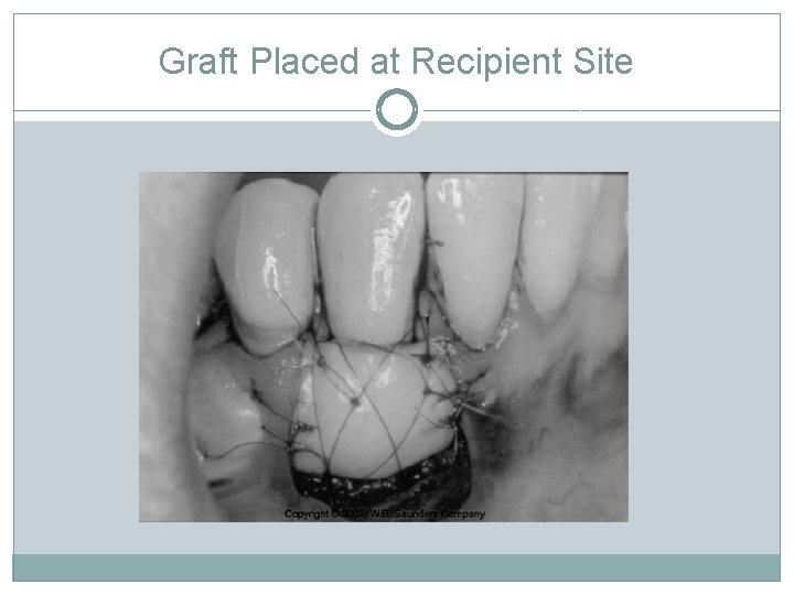 Graft Placed at Recipient Site 