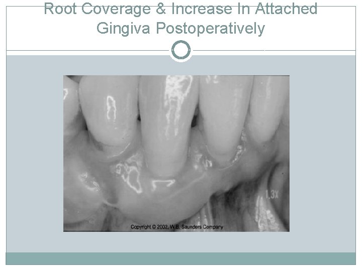 Root Coverage & Increase In Attached Gingiva Postoperatively 