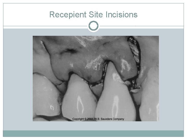 Recepient Site Incisions 