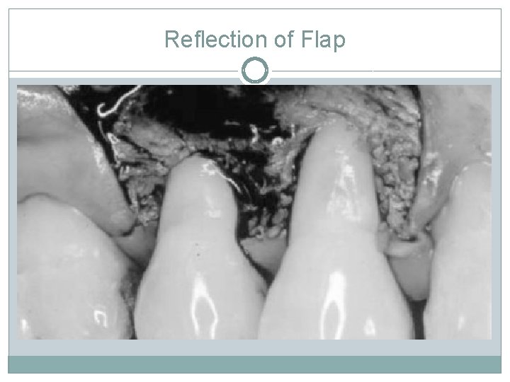 Reflection of Flap 