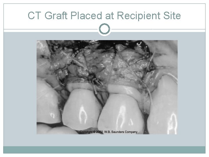 CT Graft Placed at Recipient Site 