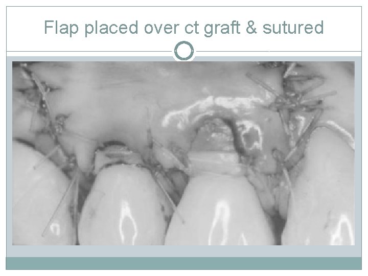 Flap placed over ct graft & sutured 