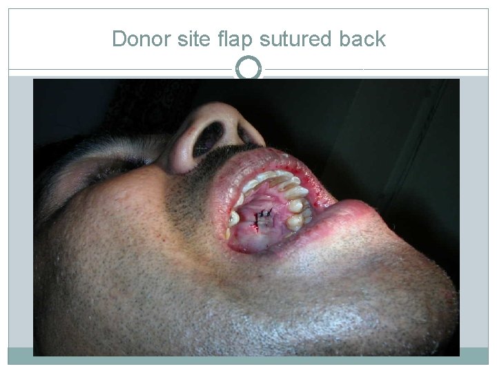 Donor site flap sutured back 