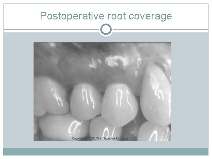 Postoperative root coverage 