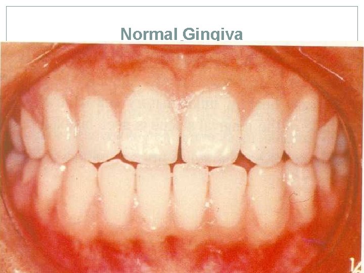 Normal Gingiva 