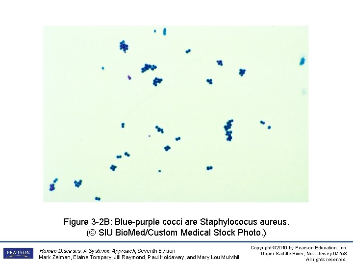 Figure 3 -2 B: Blue-purple cocci are Staphylococus aureus. (© SIU Bio. Med/Custom Medical