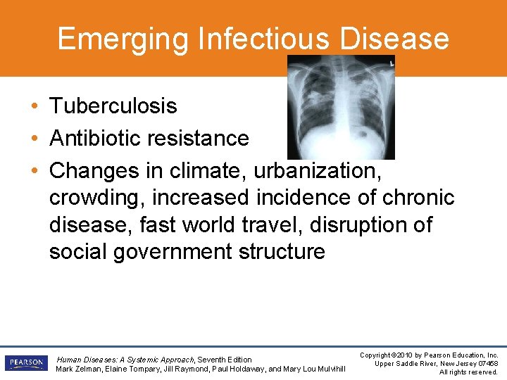 Emerging Infectious Disease • Tuberculosis • Antibiotic resistance • Changes in climate, urbanization, crowding,