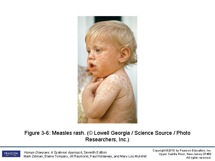 Figure 3 -6: Measles rash. (© Lowell Georgia / Science Source / Photo Researchers,