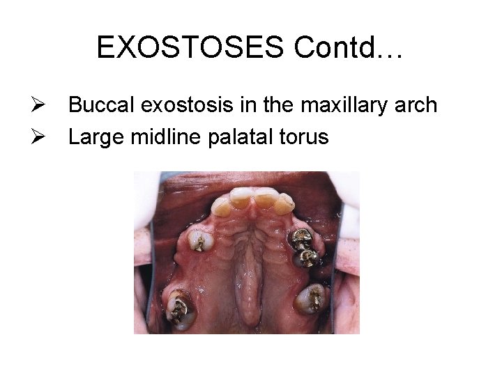 EXOSTOSES Contd… Ø Buccal exostosis in the maxillary arch Ø Large midline palatal torus