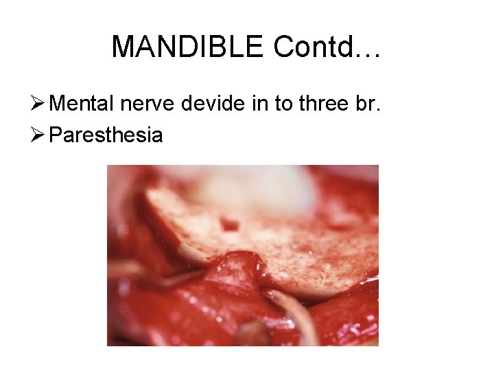 MANDIBLE Contd… Ø Mental nerve devide in to three br. Ø Paresthesia 