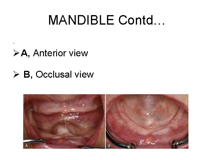 MANDIBLE Contd…. Ø A, Anterior view Ø B, Occlusal view 