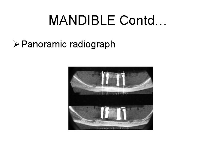 MANDIBLE Contd… Ø Panoramic radiograph 