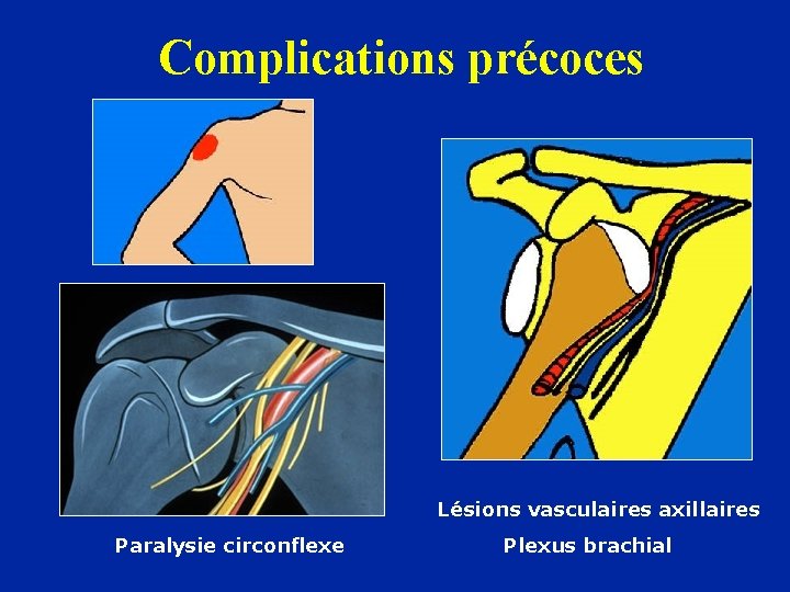 Complications précoces Paralysie circonflexe Lésions vasculaires axillaires Plexus brachial 