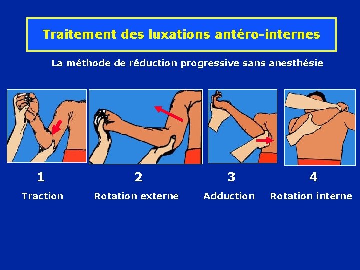 Traitement des luxations antéro-internes La méthode de réduction progressive sans anesthésie 1 Traction 2