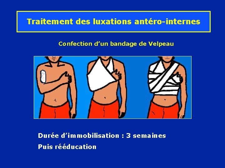 Traitement des luxations antéro-internes Confection d’un bandage de Velpeau Durée d’immobilisation : 3 semaines