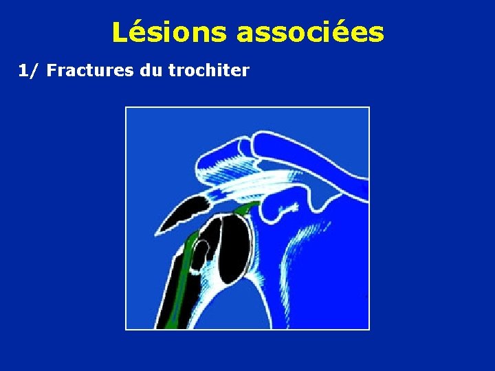 Lésions associées 1/ Fractures du trochiter 