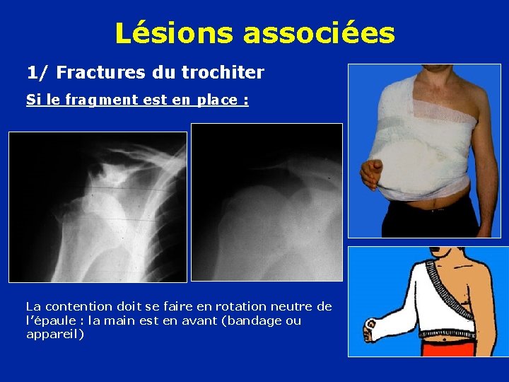 Lésions associées 1/ Fractures du trochiter Si le fragment est en place : La