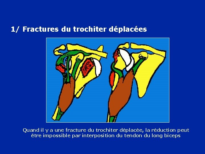 1/ Fractures du trochiter déplacées Quand il y a une fracture du trochiter déplacée,