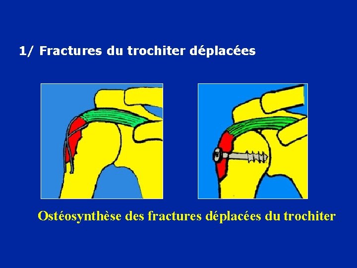 1/ Fractures du trochiter déplacées Ostéosynthèse des fractures déplacées du trochiter 