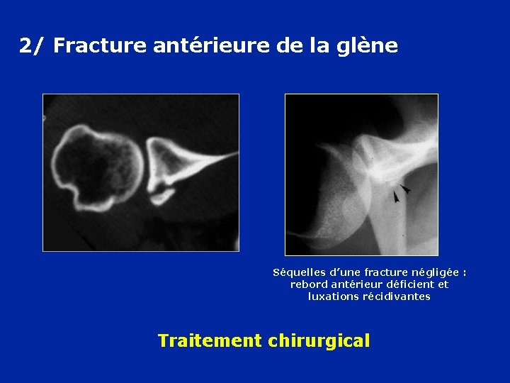 2/ Fracture antérieure de la glène Séquelles d’une fracture négligée : rebord antérieur déficient