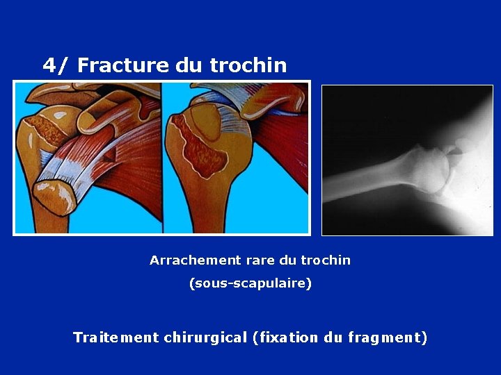 4/ Fracture du trochin Arrachement rare du trochin (sous-scapulaire) Traitement chirurgical (fixation du fragment)