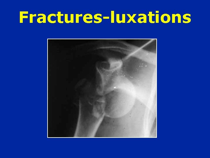 Fractures-luxations 