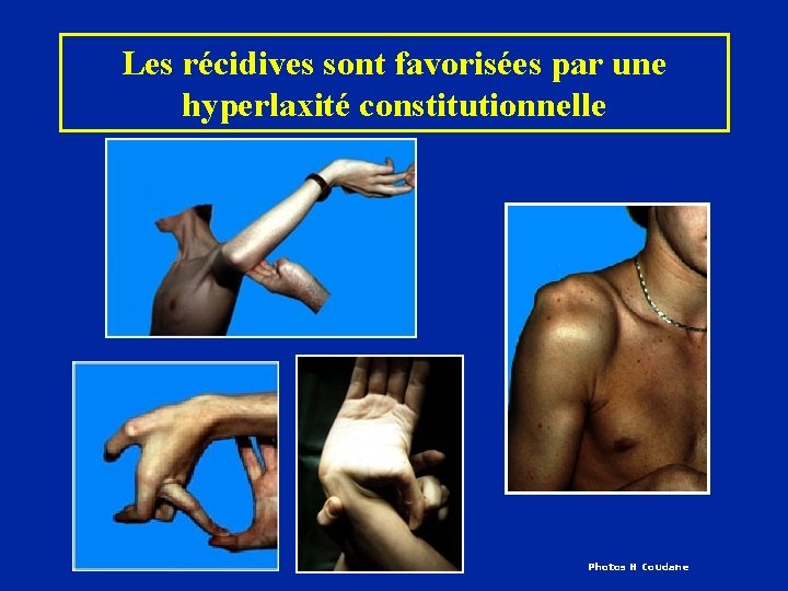 Les récidives sont favorisées par une hyperlaxité constitutionnelle Photos H Coudane 